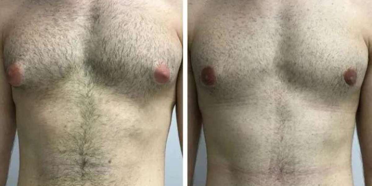 The Role of Hormone Testing in Diagnosing Gynecomastia in Dubai