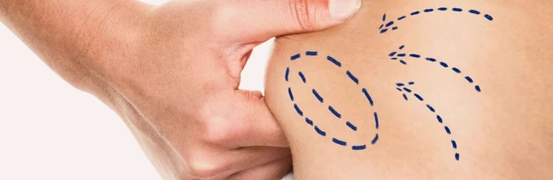 Liposuction Surgery Cover Image