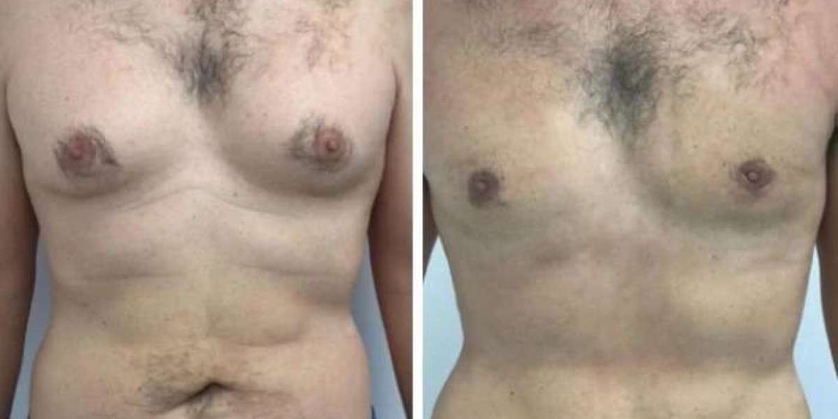 Lifestyle Changes Recommended by the Best Gynecomastia Surgeons in dubai