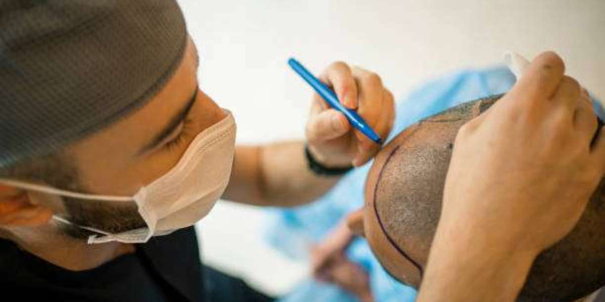 What Are the Different Types of Hair Transplant Methods Available?