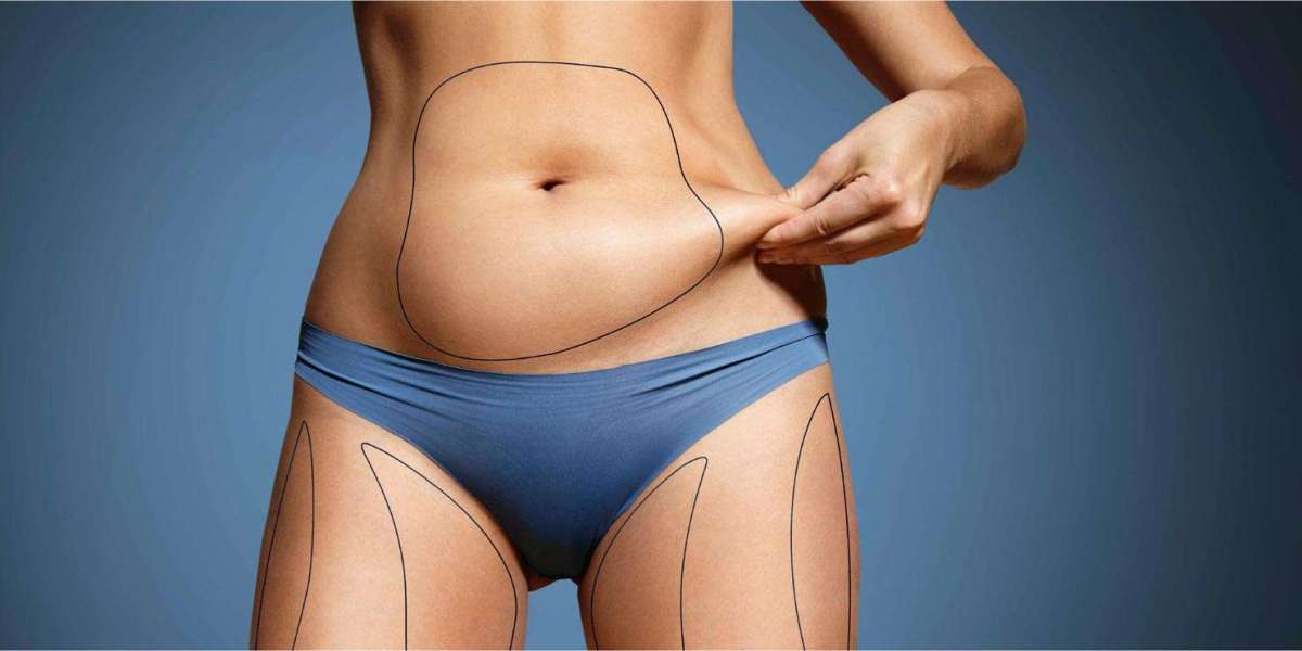 Tips for Finding the Best Tummy Tuck Surgeon in Dubai for Natural Results