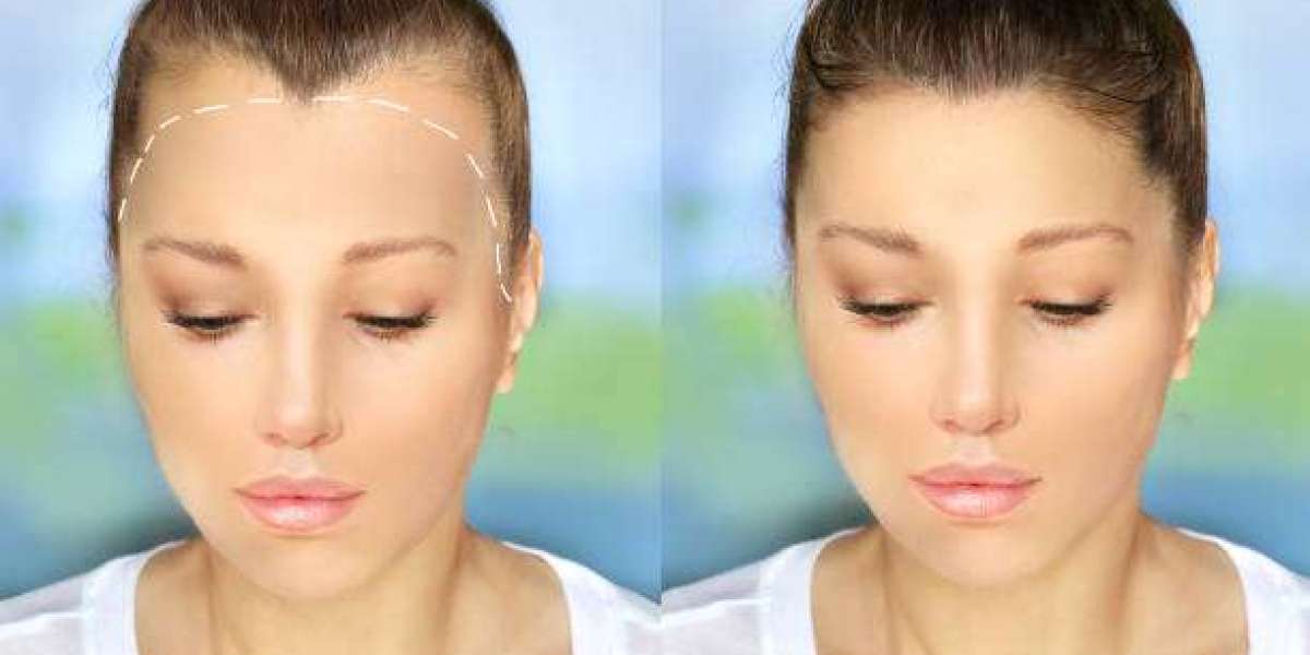 The Science of Achieving Hair Transplant in Riyadh