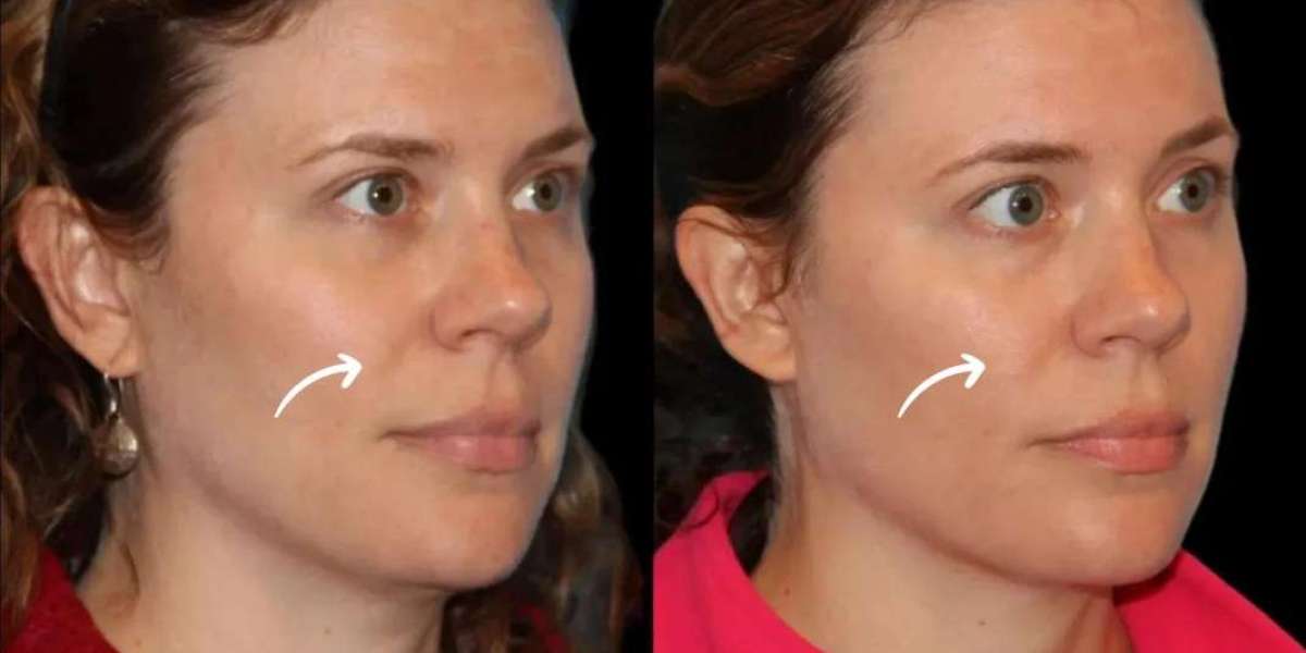 Sculptra in Dubai for Natural Volume Restoration