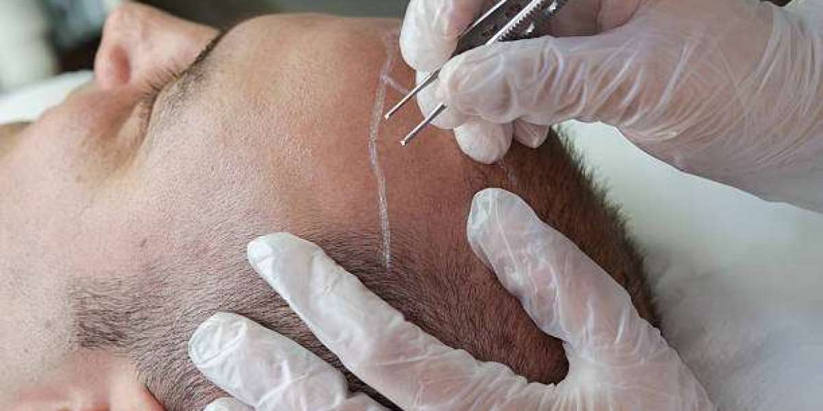 What Is the Relationship Between Hair Loss Severity and Procedure Cost?