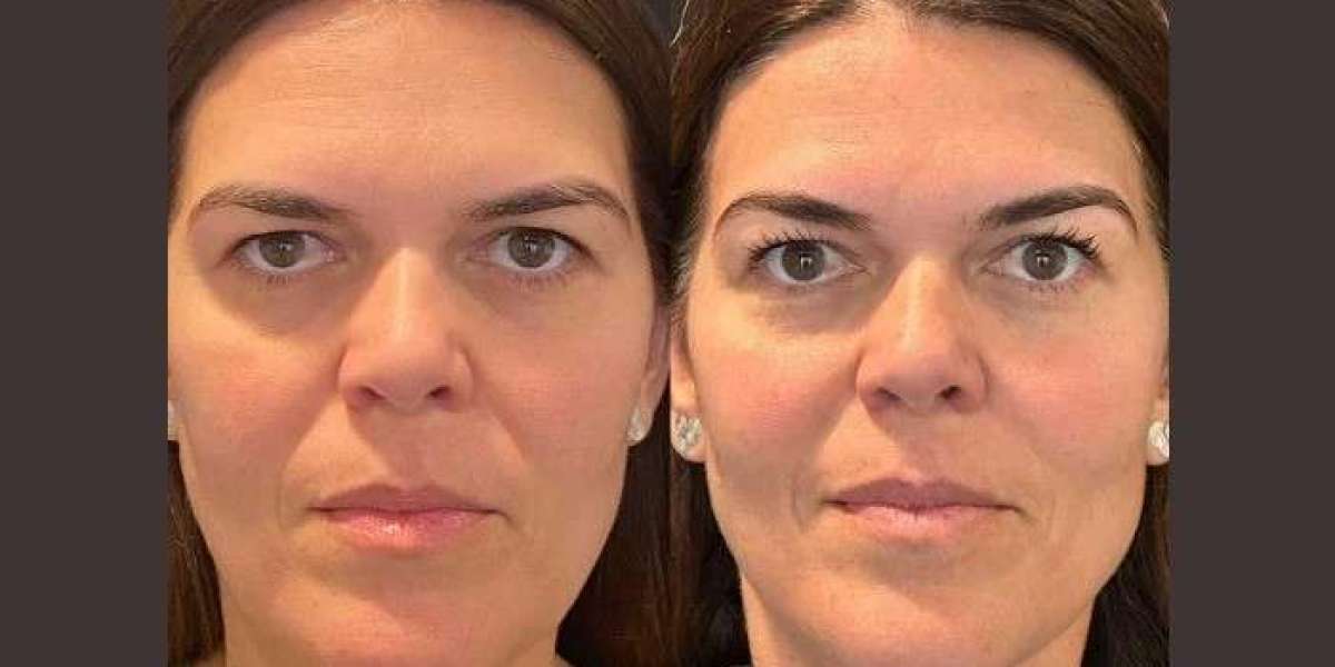 Best Doctors in dubai Compare Thread Lift and Surgical Facelift