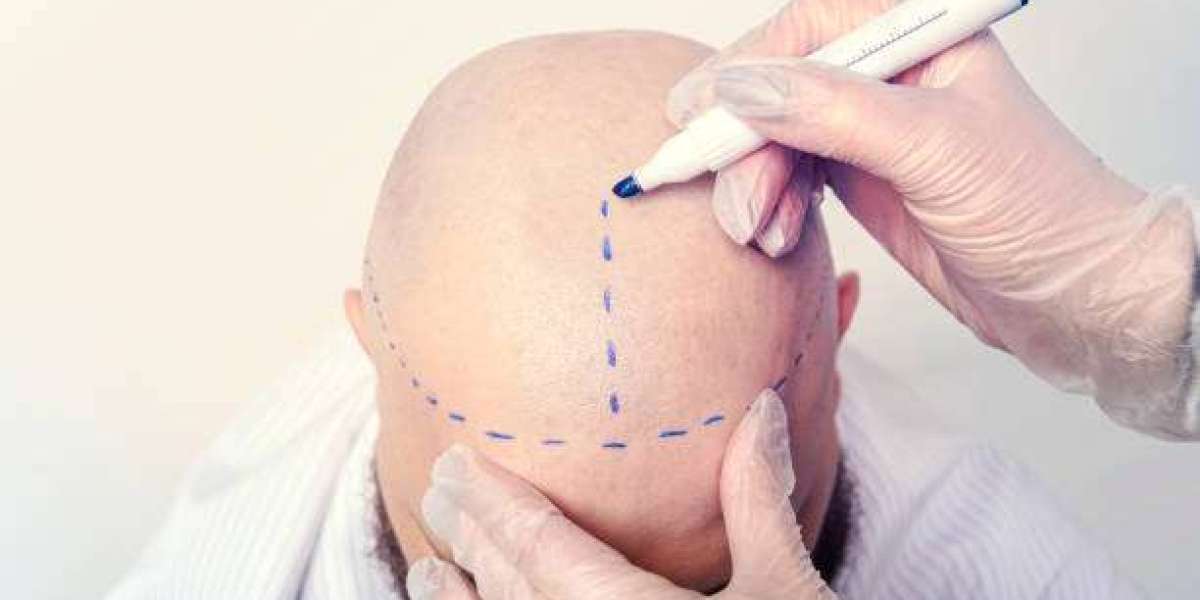 Hair Transplant Touch-Ups: Perfecting Results Over Time