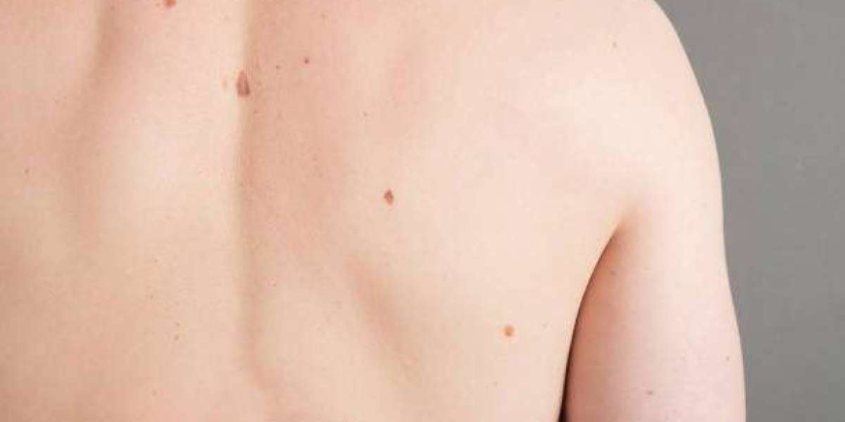 Mole Removal Techniques for Skin Perfection