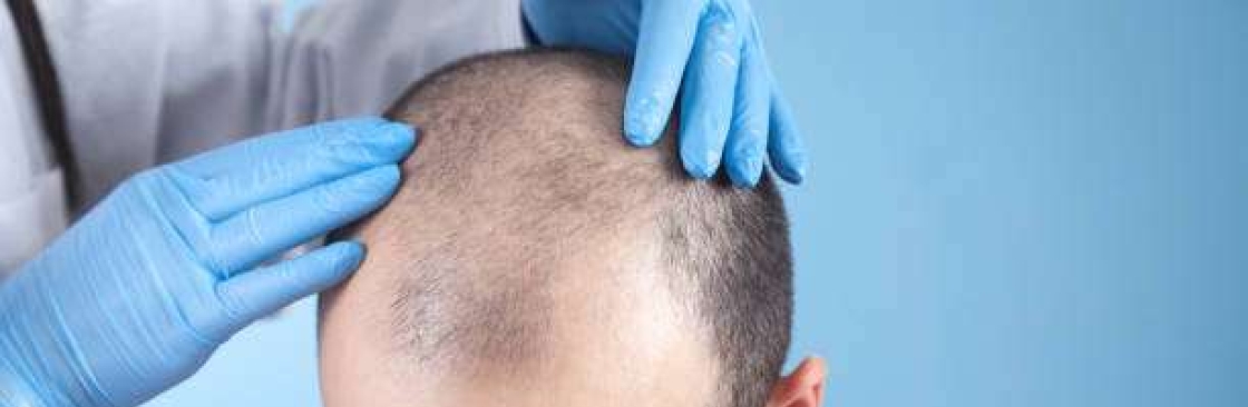 hairtransplant Cover Image