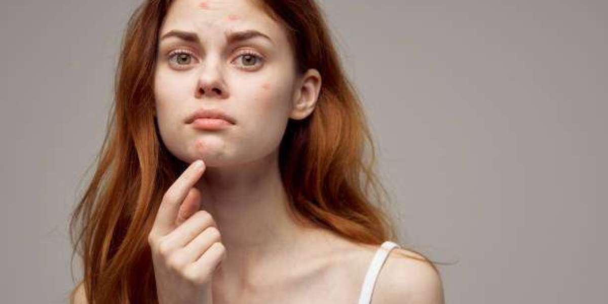 How to Prevent Acne After Treatment?