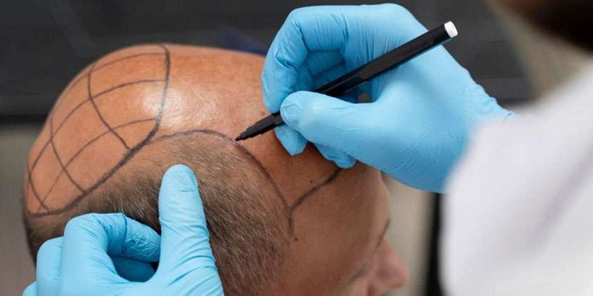 FUE Hair Transplant in Dubai: Who Is Eligible