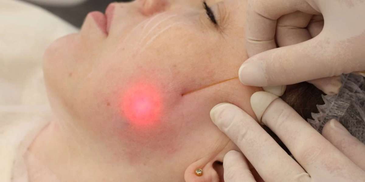 Endolift Treatment in Dubai: Benefits, Procedure, and Recovery