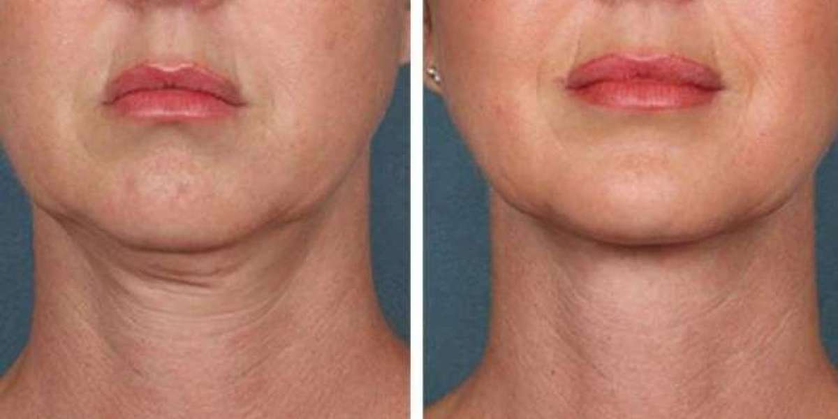 PRP Treatment in Dubai Powering Smart Follicle Regeneration