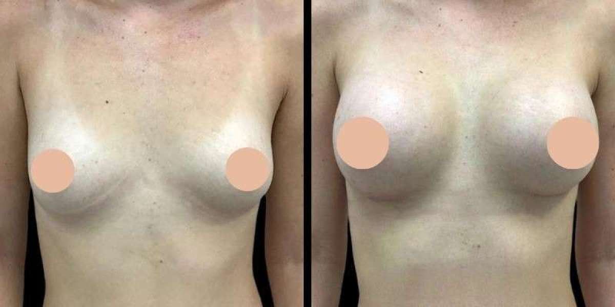 Breast Augmentation in Dubai: What to Expect Before Surgery