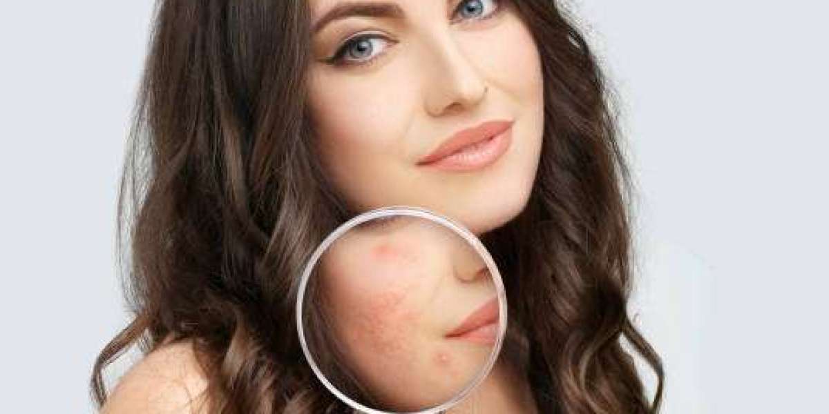 Choosing the Best Acid for Acne in Dubai: Salicylic vs. Mandelic Acid