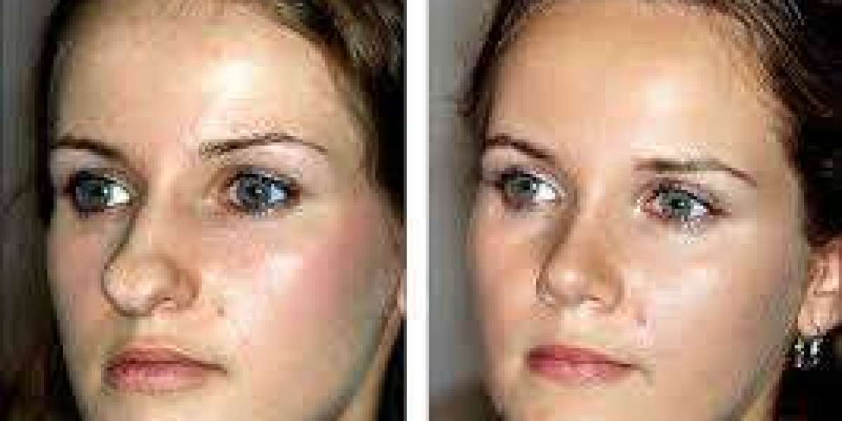 Rhinoplasty in Dubai: Natural Looking Results Tips