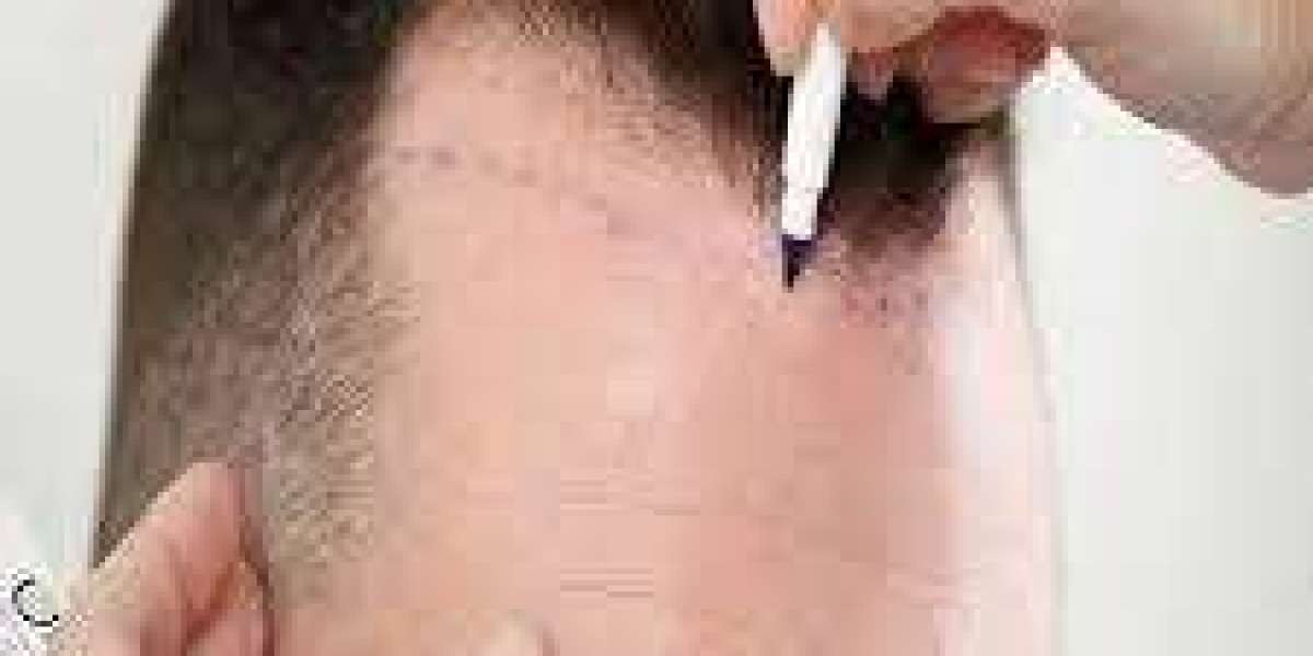 Hair Transplant in Dubai Hairline Design Trends Guide