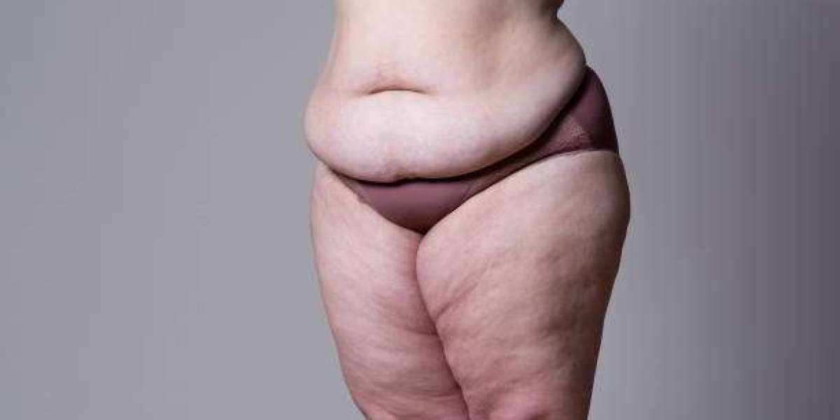 Tummy Tuck Surgery in Dubai: Before, During, and After Guide