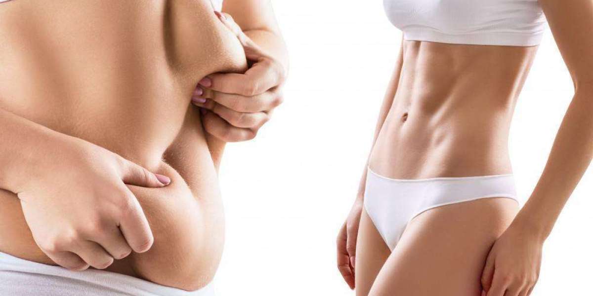 Enhance Your Self Image Through Liposuction Surgery in Dubai
