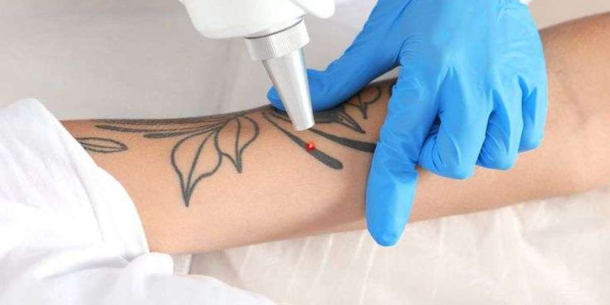 Effective Laser Tattoo Removal in Dubai for Colors
