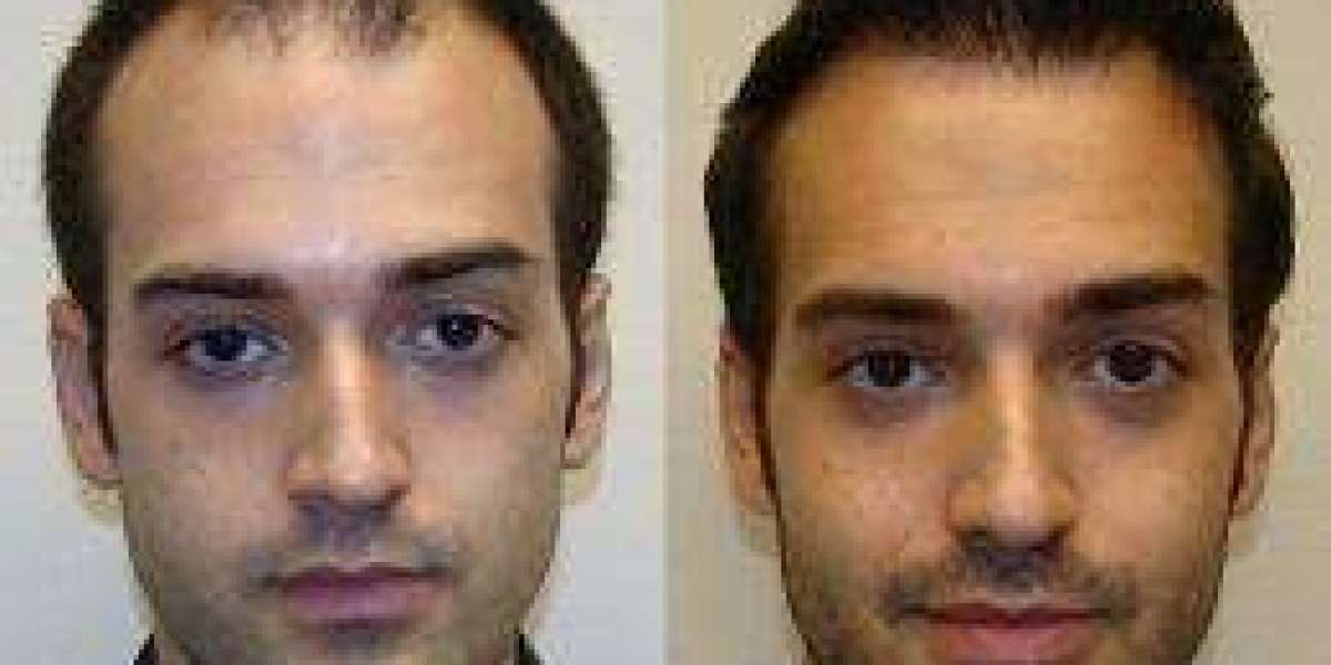 Hair Transplant Cost in Dubai Price Trends Explained UAE