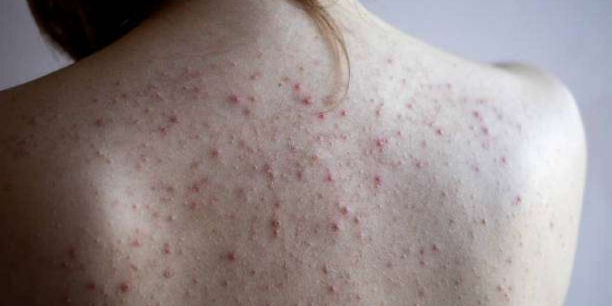 How to Treat Back Acne and Its Effects? Travel Skincare for Back Acne