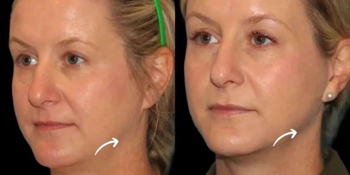 Sculptra in Dubai Treatment Reviews