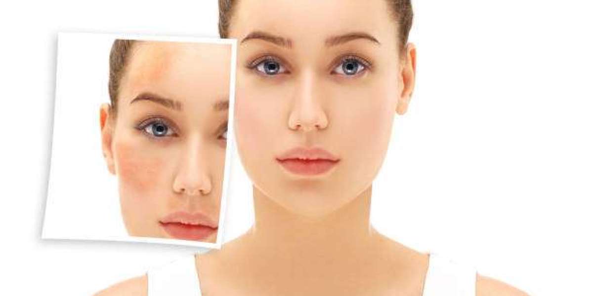 Benefits of Laser Skin Peeling in Dubai for Glow