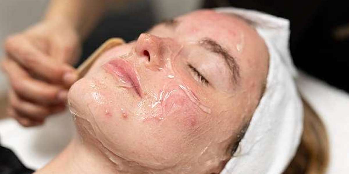 Inno Peeling in Dubai for Large Pores and Texture