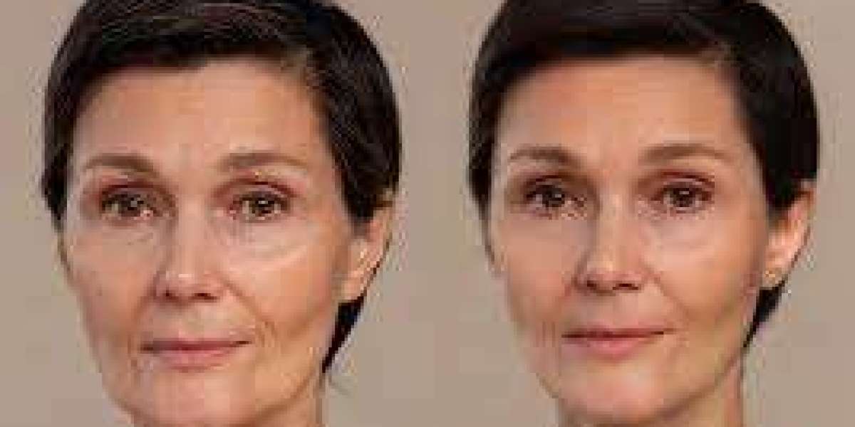 Facelift in Dubai Natural Facial Rejuvenation Solutions
