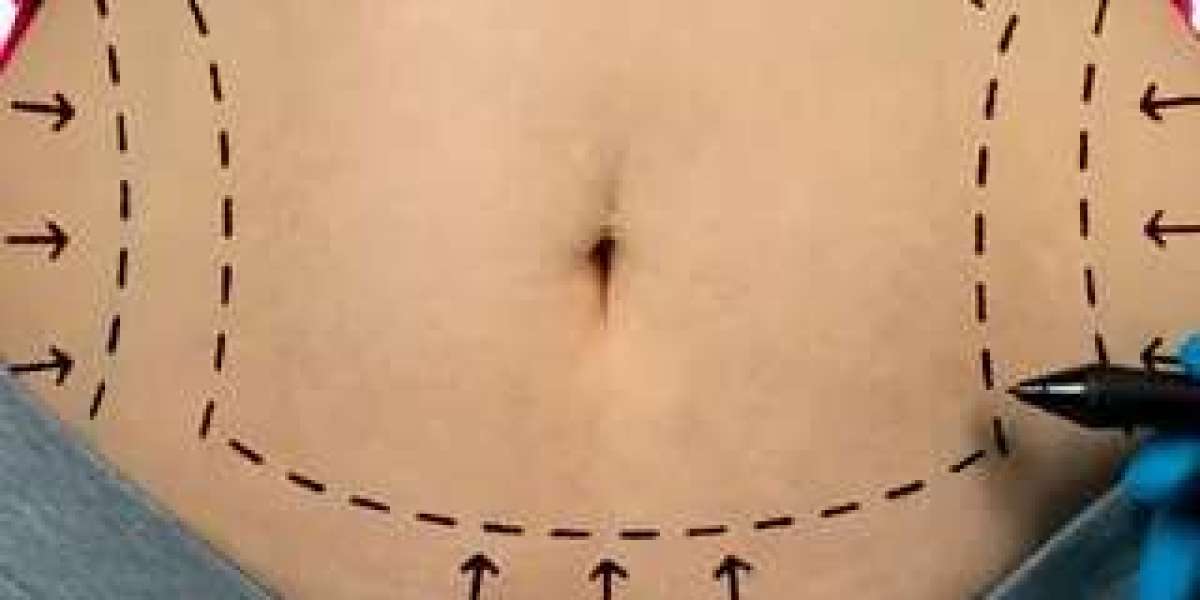 Expert Tips for a Smooth Recovery After Fat Grafting in Riyadh