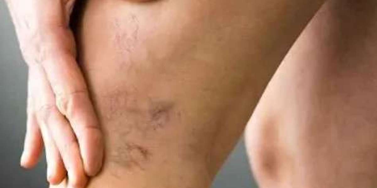 Varicose Veins Treatment In Dubai – Safe Solutions for Healthier, Smoother Legs