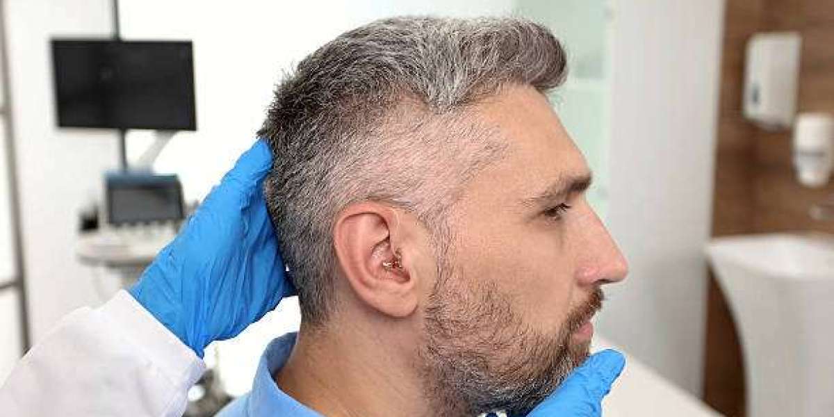 How to Prepare for Hair Transplant in Dubai: A Step-by-Step Guide