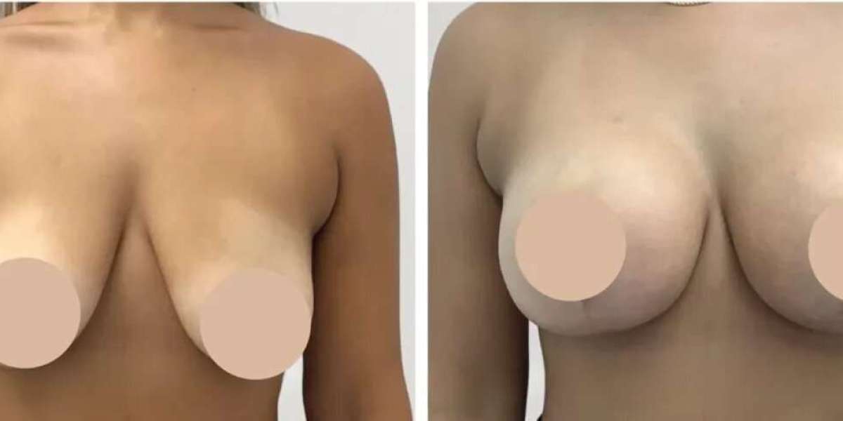 Best Doctors in Dubai for Breast Reduction and Recovery Care