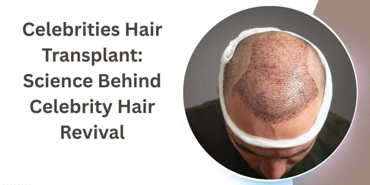 Celebrities Hair Transplant: Science Behind Celebrity Hair Revival