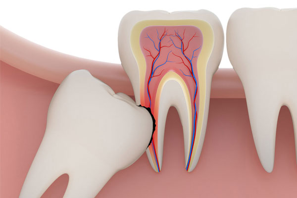 Wisdom Teeth Removal Canberra | Wisdom Teeth Canberra