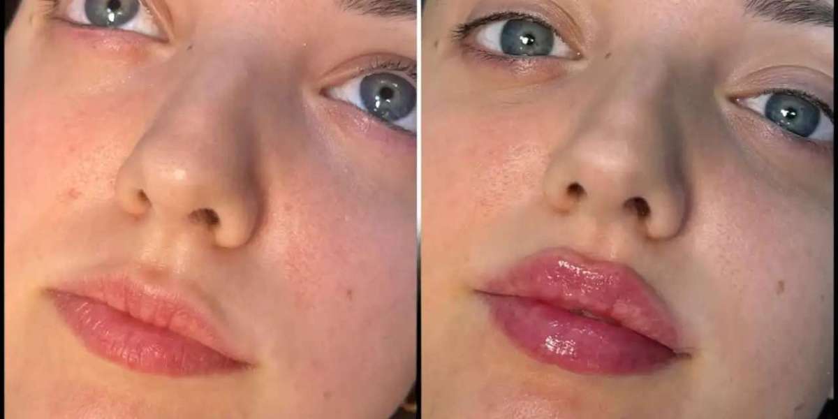 Achieve Stunning Results with Fillers at the Best Aesthetic Clinic in Dubai