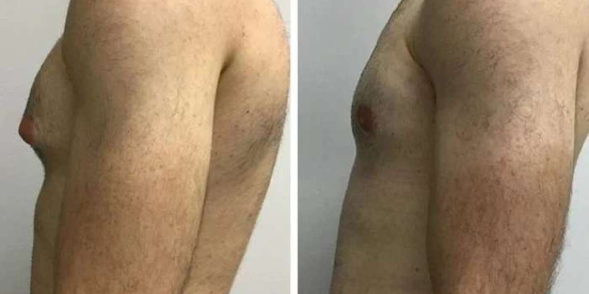 Best Gynecomastia Surgeon in Dubai: Qualifications and Experience That Matter Most