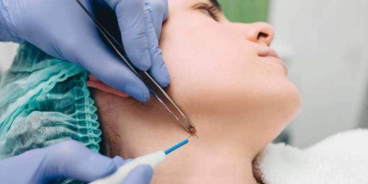Mole Removal in Dubai for Men: Facial and Body Moles