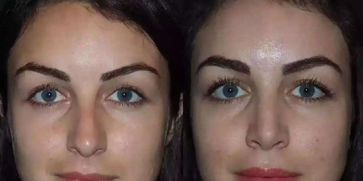 How Best Septoplasty Surgeons in Dubai Improve Breathing