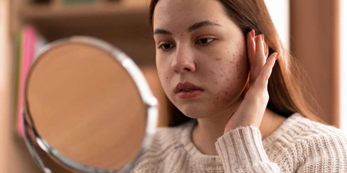 7 Important Things to Know About Acne Scar Treatment Toronto
