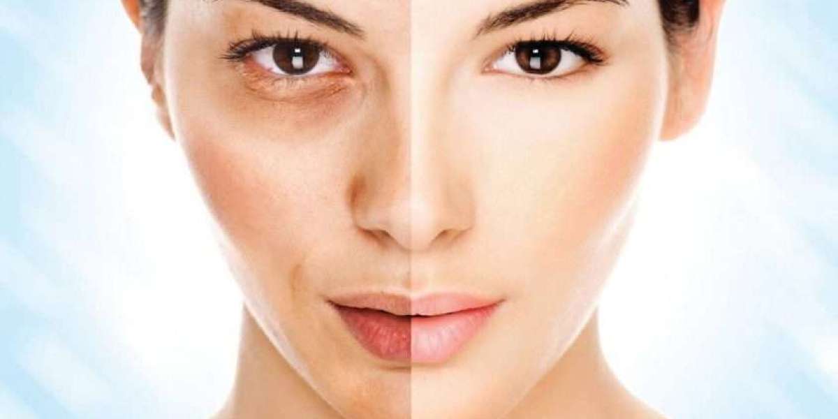 Before and After: Melasma Treatment Results Explained