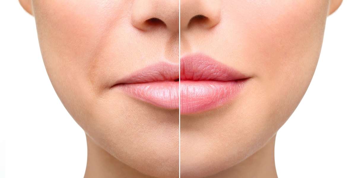 Managing Swelling and Bruising After Lip Filler Injections