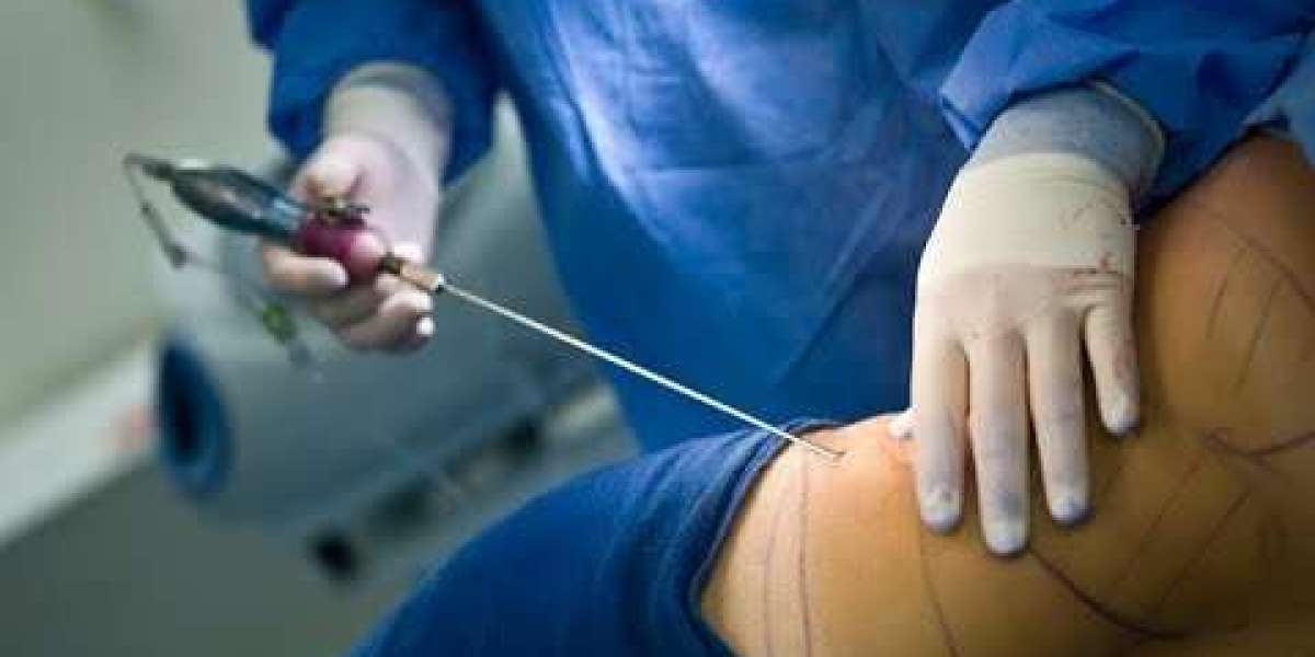 شفط الدهون في الرياض وتحسين مظهر الجسم