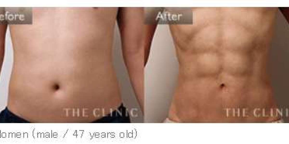 Who Is an Ideal Candidate for Vaser 4D Liposuction in Riyadh?