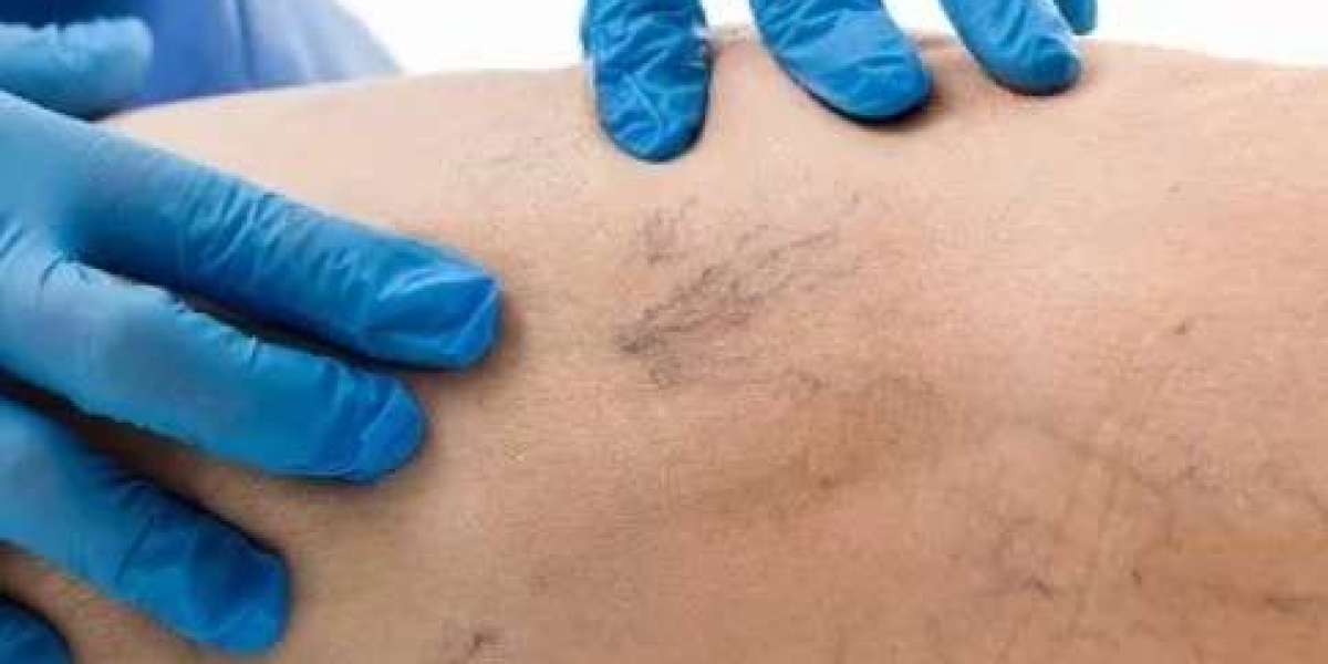 Sclerotherapy In Dubai for Visible Vein Reduction