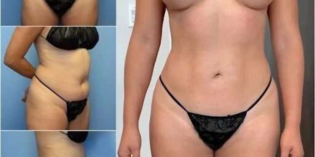 Body Contouring in Dubai for Safe Surgical Precision