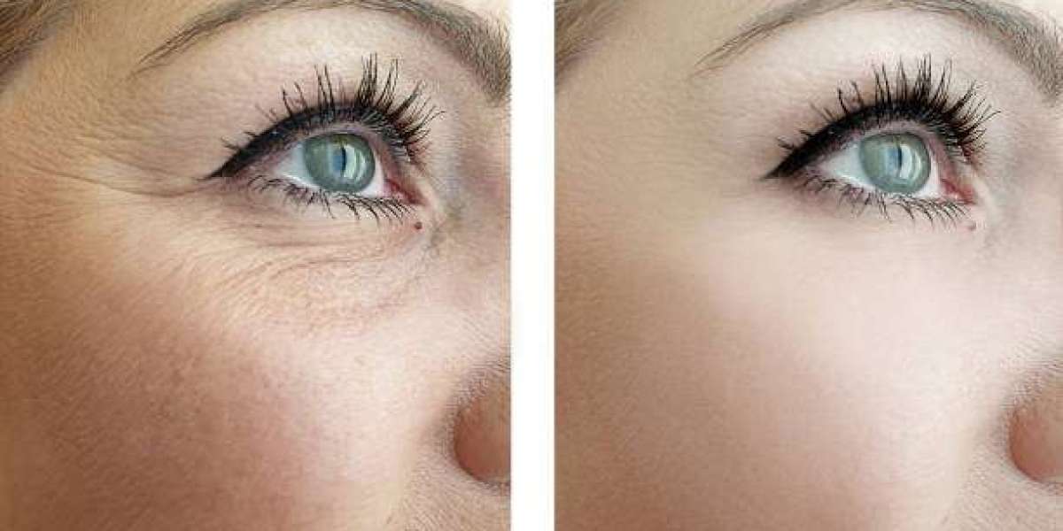 Natural Under Eye Fillers in Dubai: Achieving Perfect Results