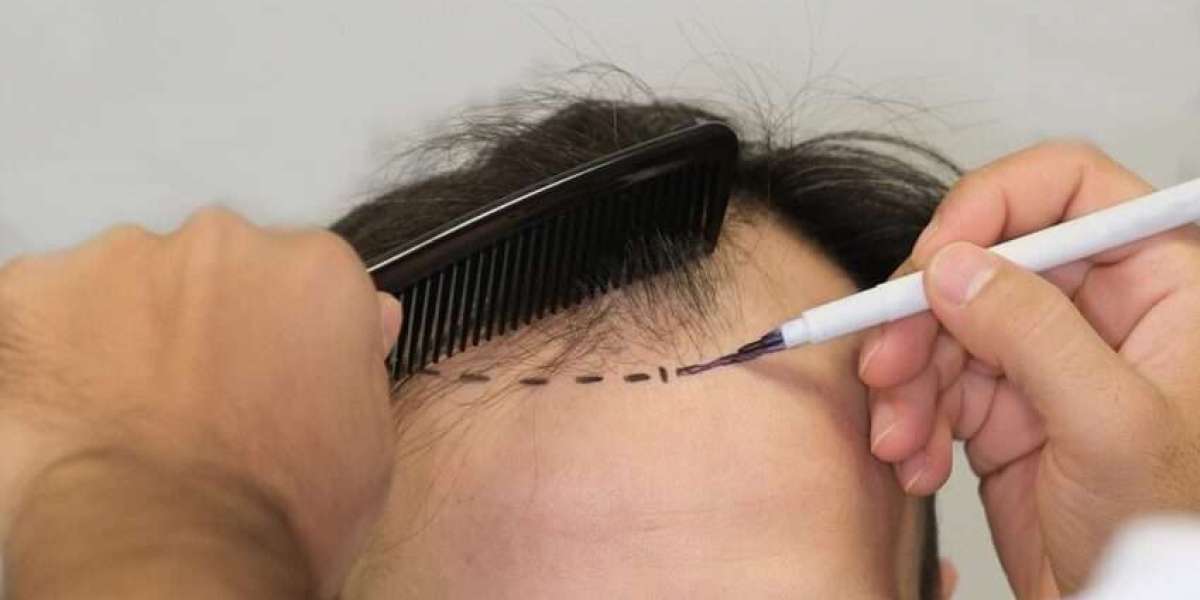 فوائد زراعة الشعر في الدمام