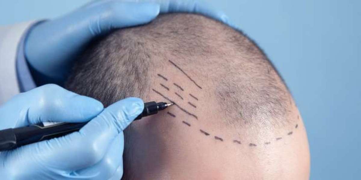 زراعة الشعر في الدمام والعناية بعد العملية