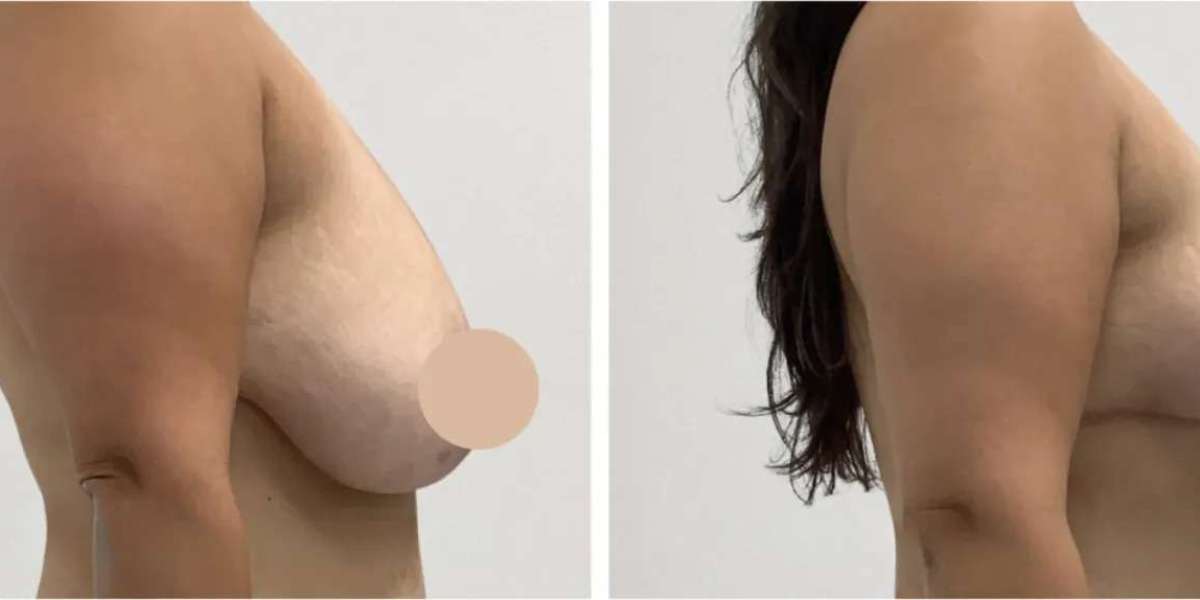 Reveal Your Best Shape with Breast Lift in Dubai